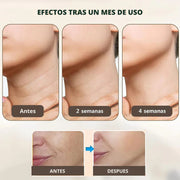 Reductor de Arrugas e Imperfecciones -  Lifting Facial™ 2